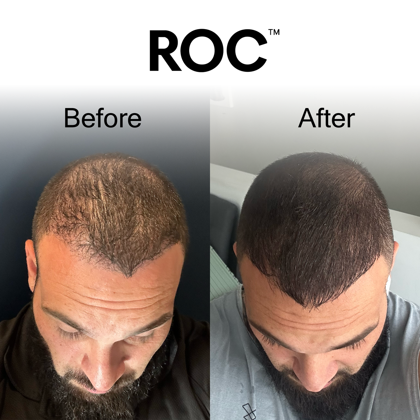 ROC™ Post-Graft Serum