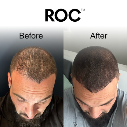 ROC™ Post-Graft Serum