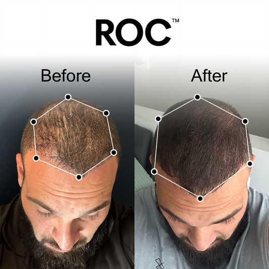 ROC™ Post-Graft Serum