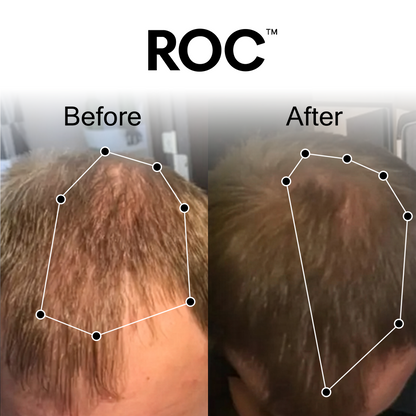 ROC™ Post-Graft Serum