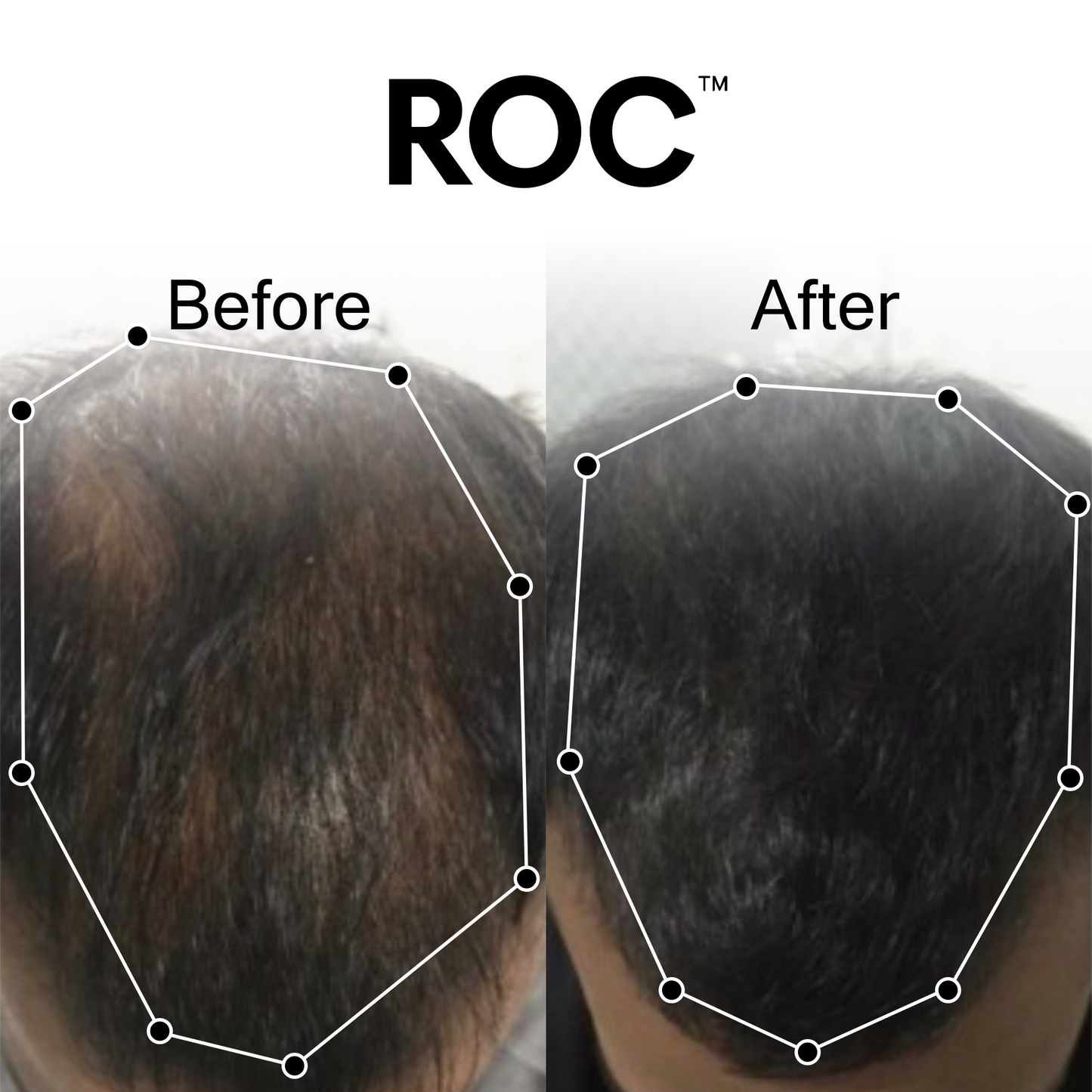 ROC™ Post-Graft Serum