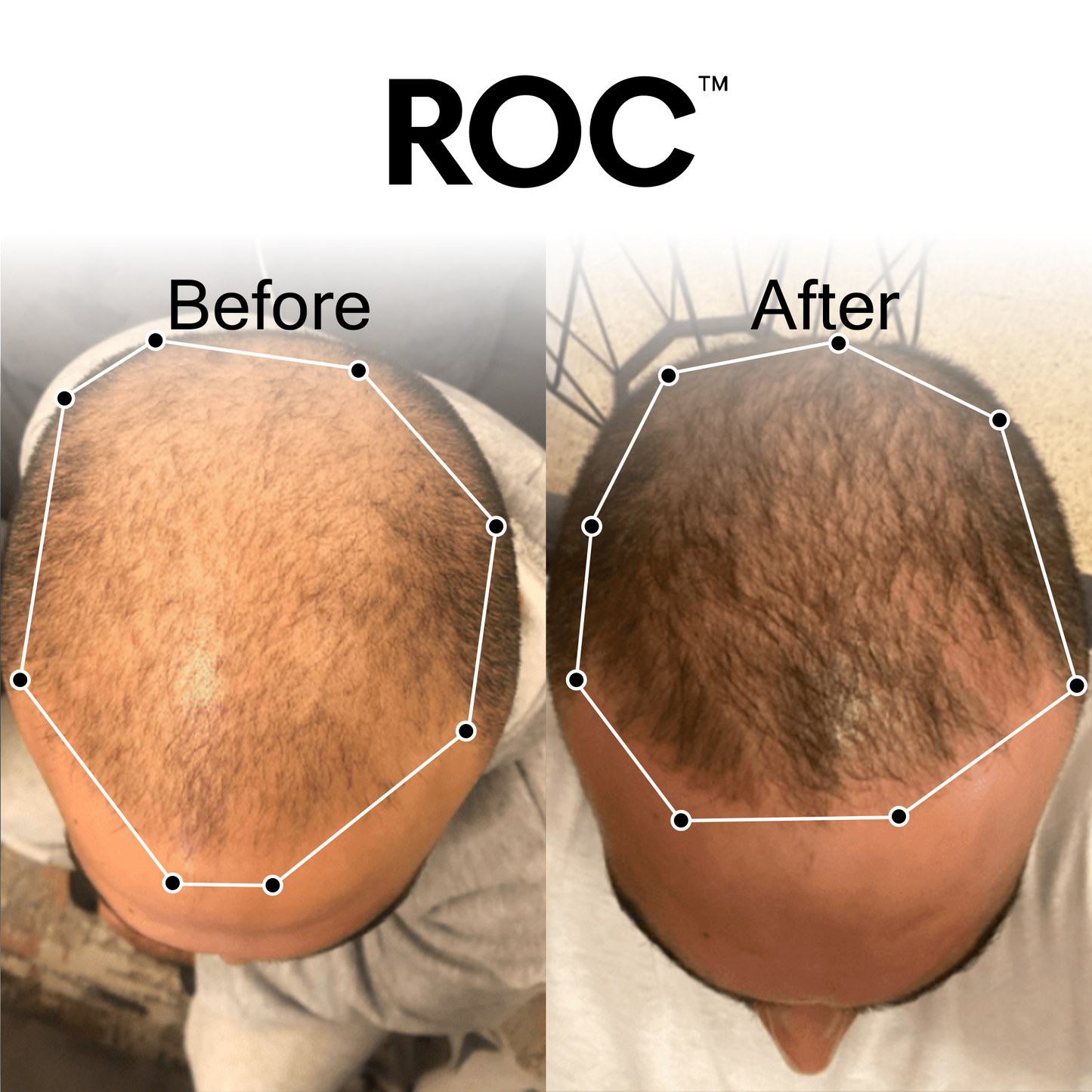 ROC™ Post-Graft Serum